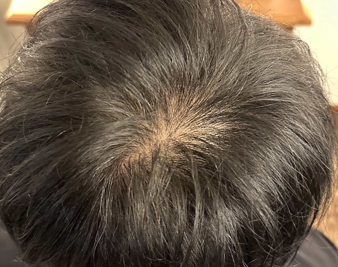 エクソソームPJ