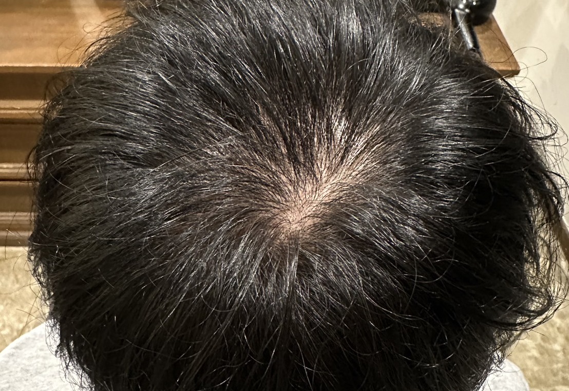 エクソソームPJ