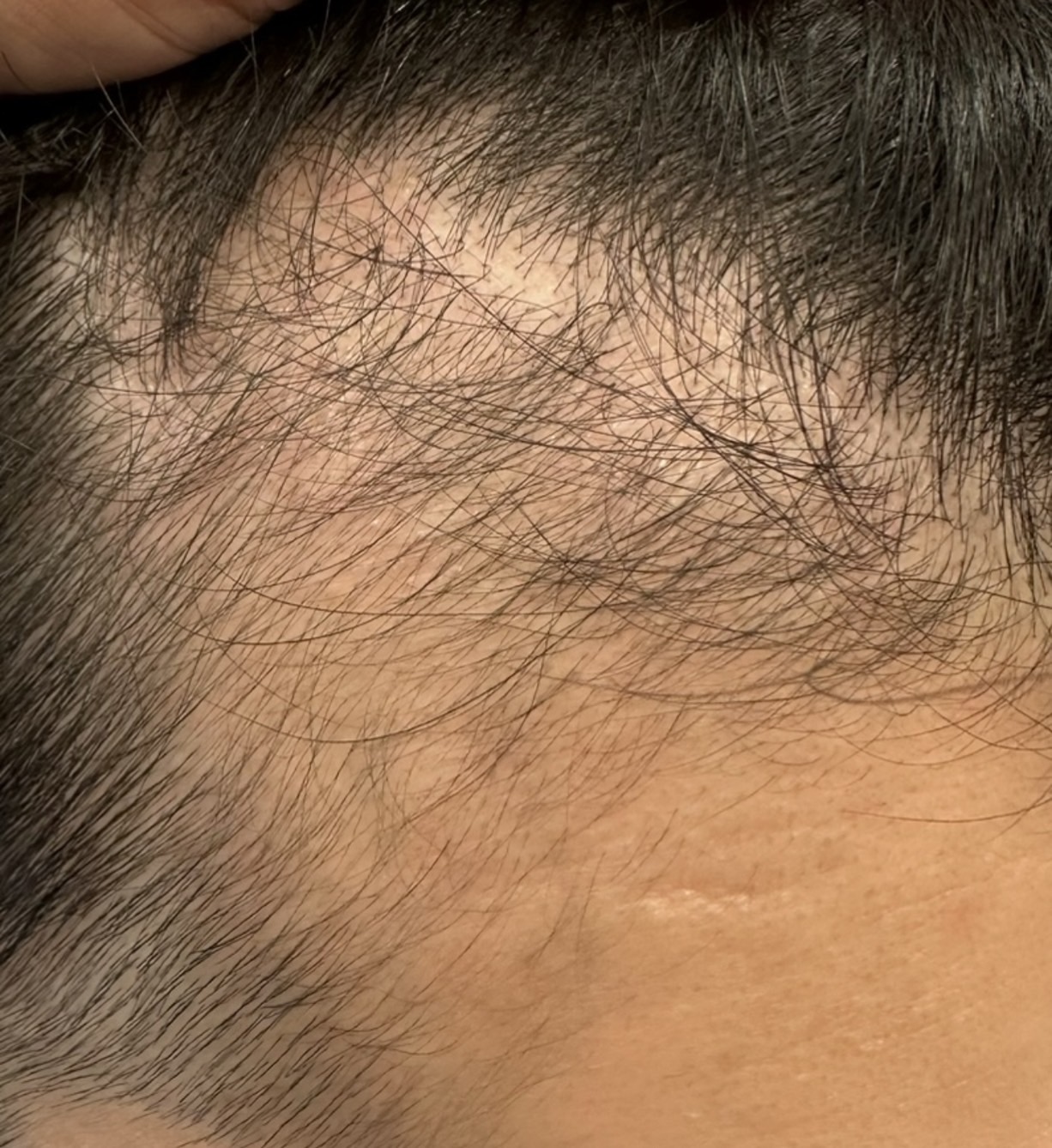 エクソソームPJ