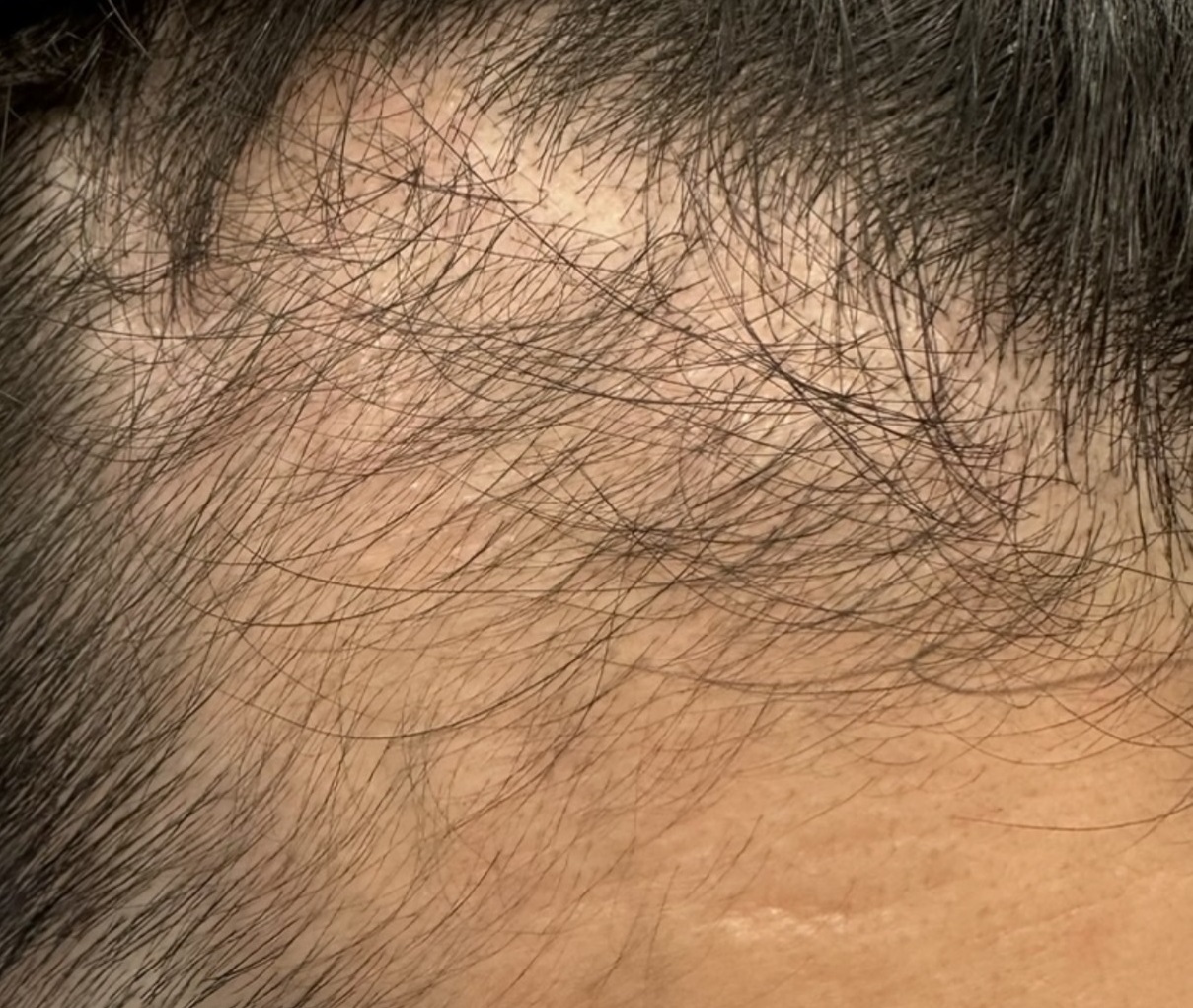 エクソソームPJ