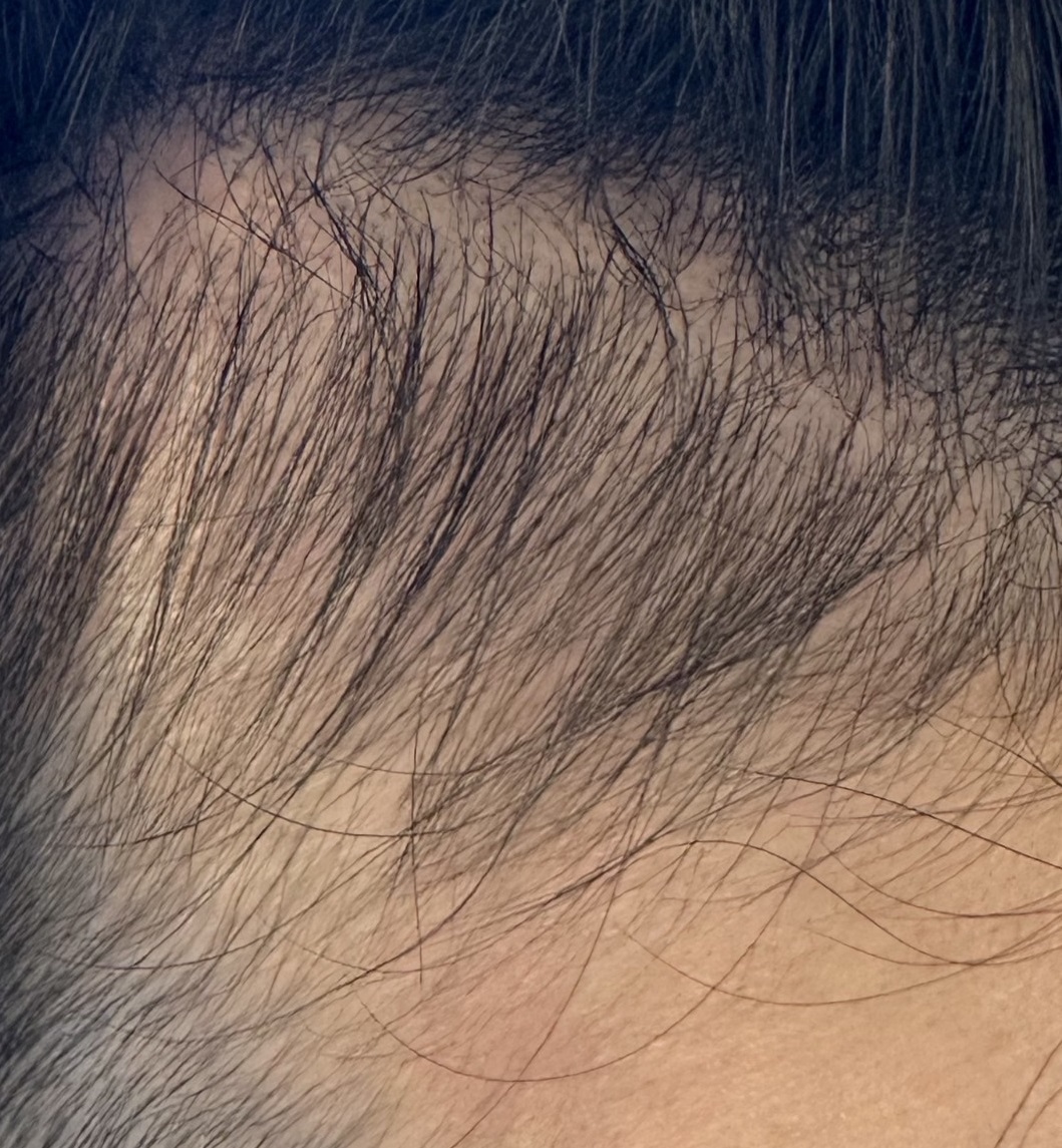 エクソソームPJ