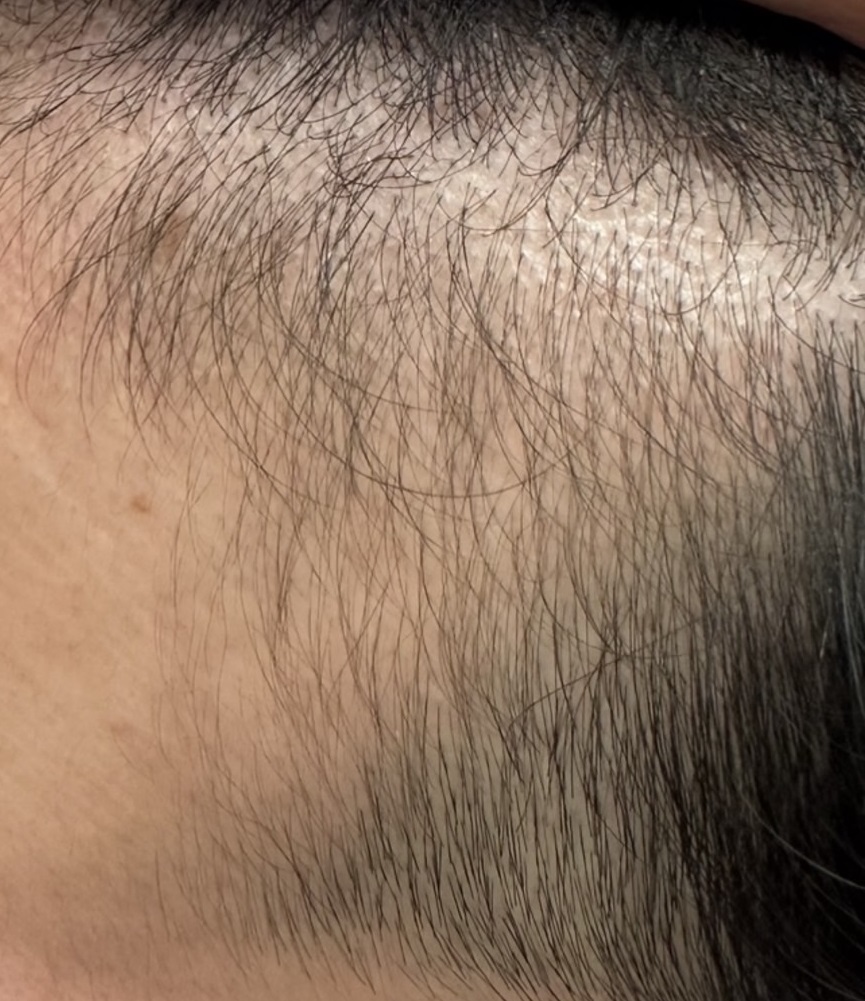 エクソソームPJ