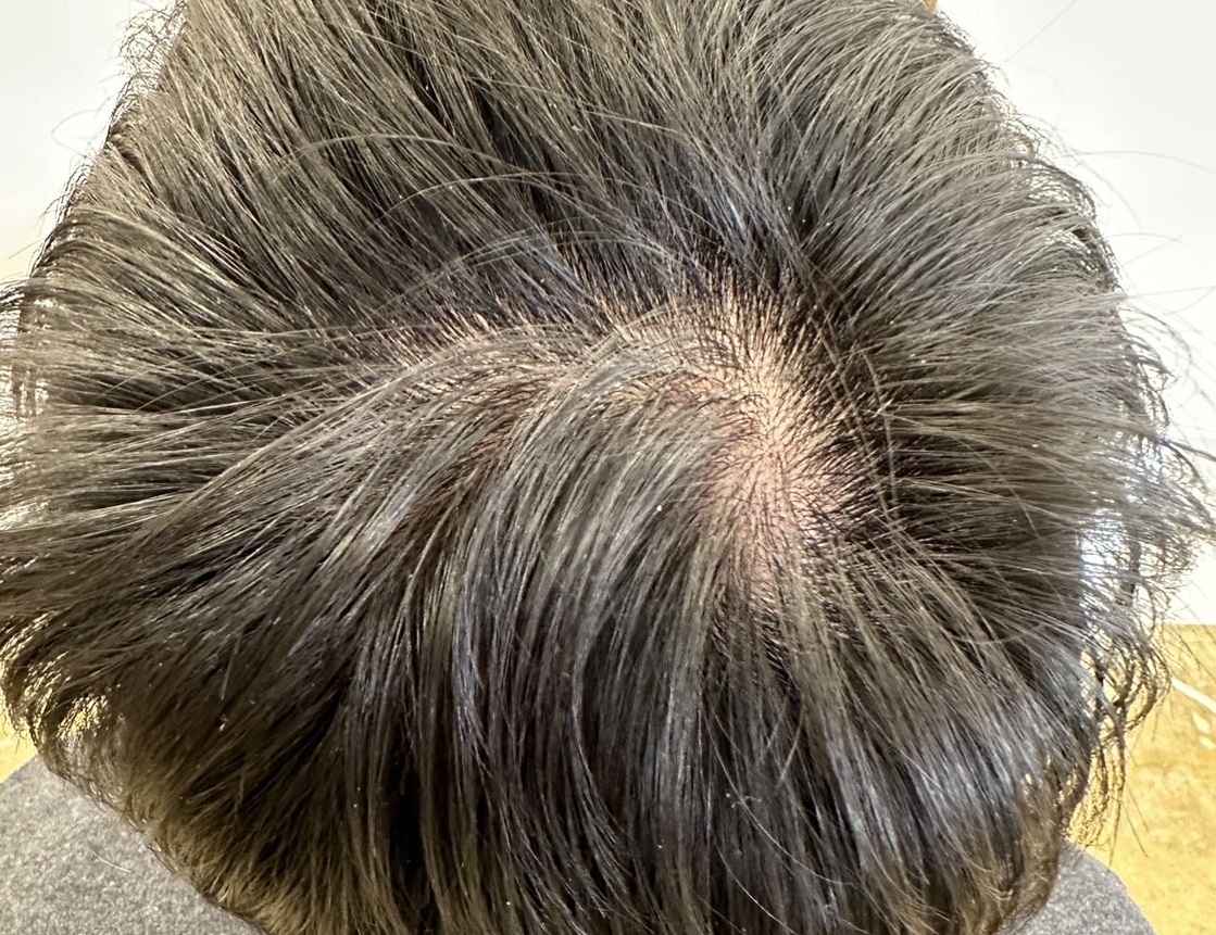 エクソソームPJ