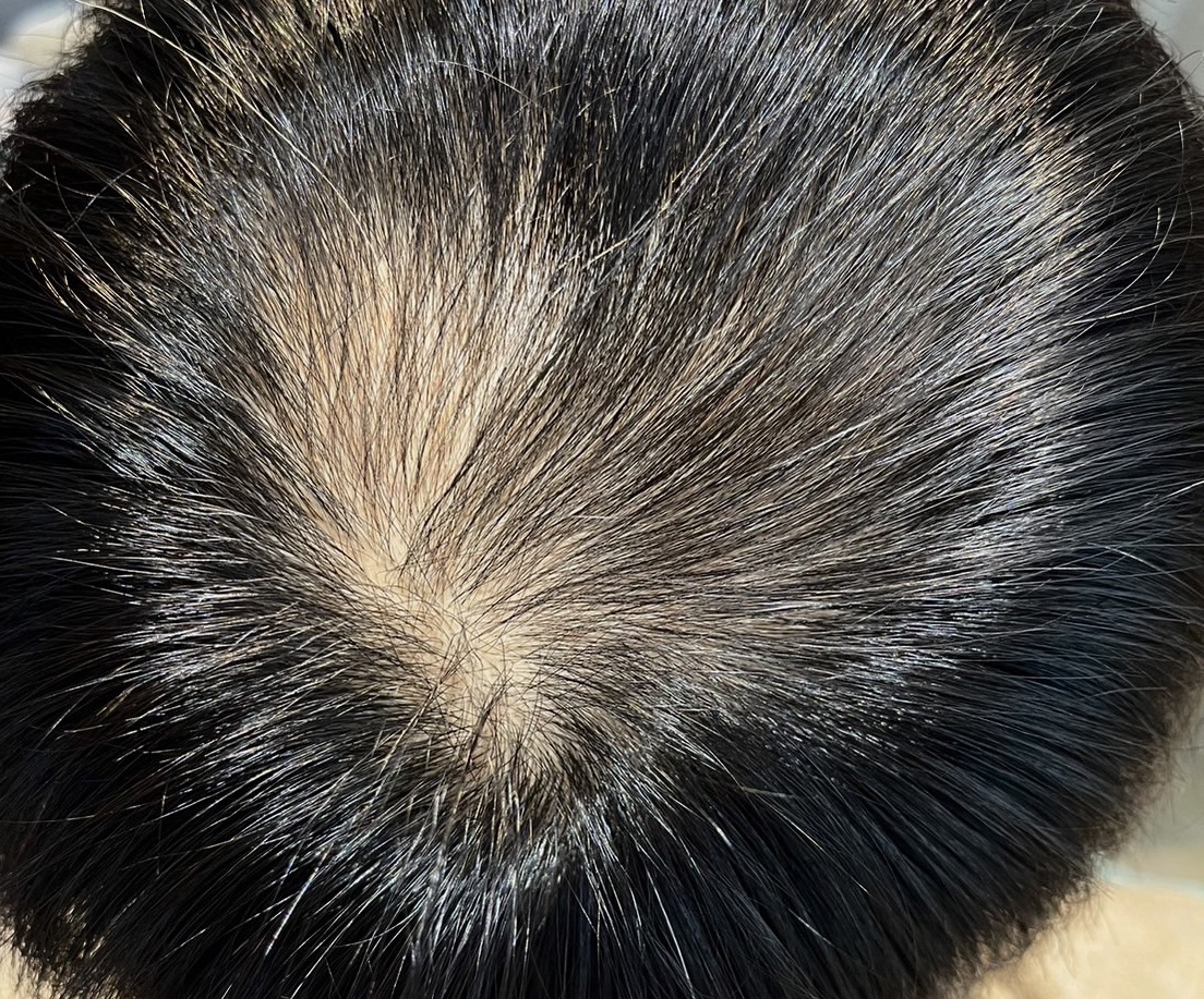 エクソソームPJ