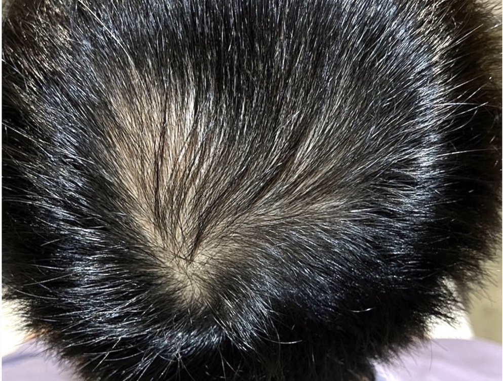 エクソソームPJ