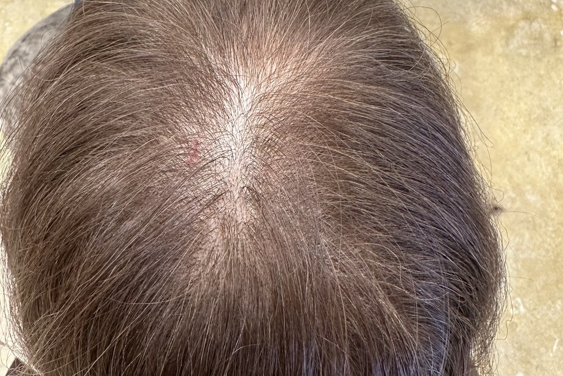 エクソソームPJ