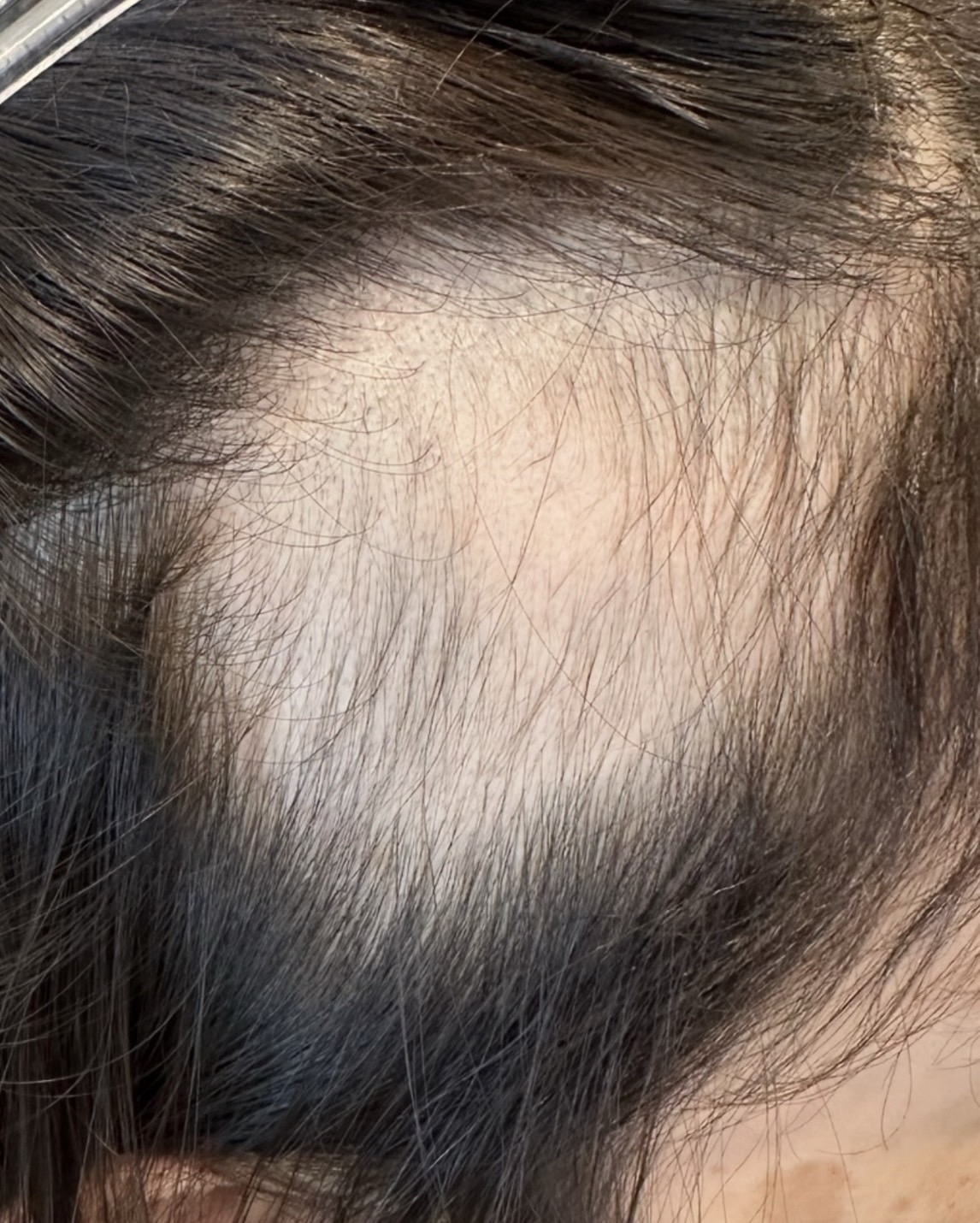 エクソソームPJ