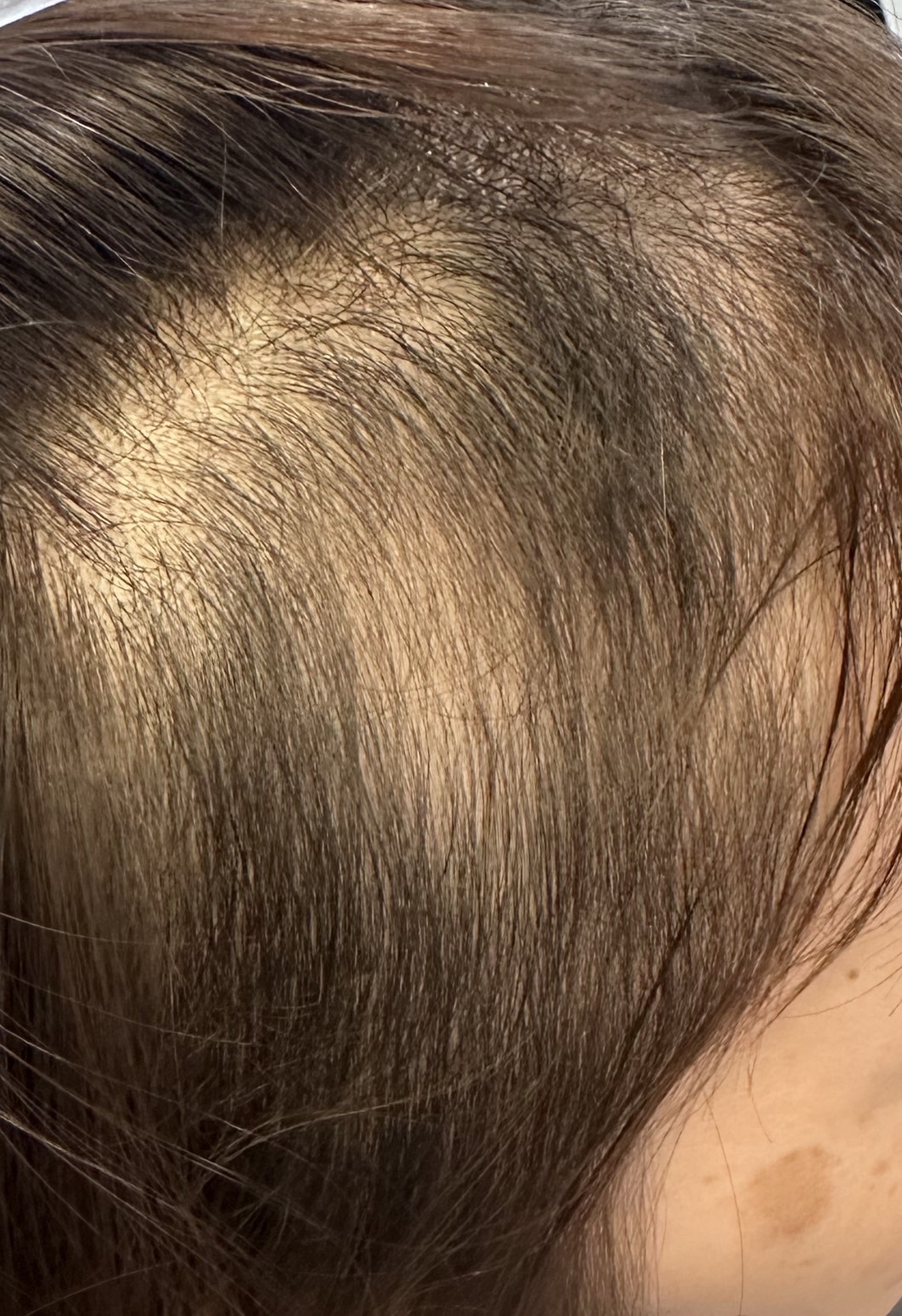 エクソソームPJ