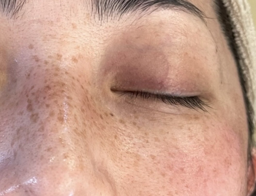 エクソソームPJ